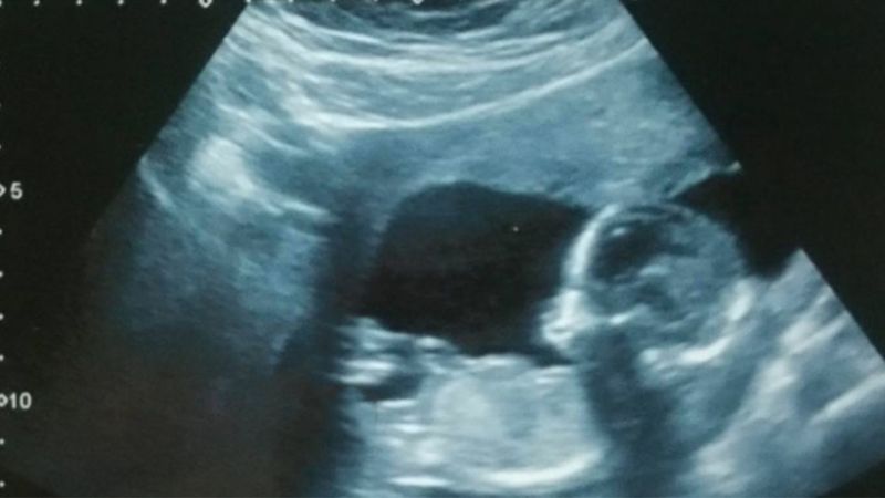 Lekarz zaproponował kobiecie aborcję. Ona się nie zgodziła i urodziła wyjątkową dziewczynkę
