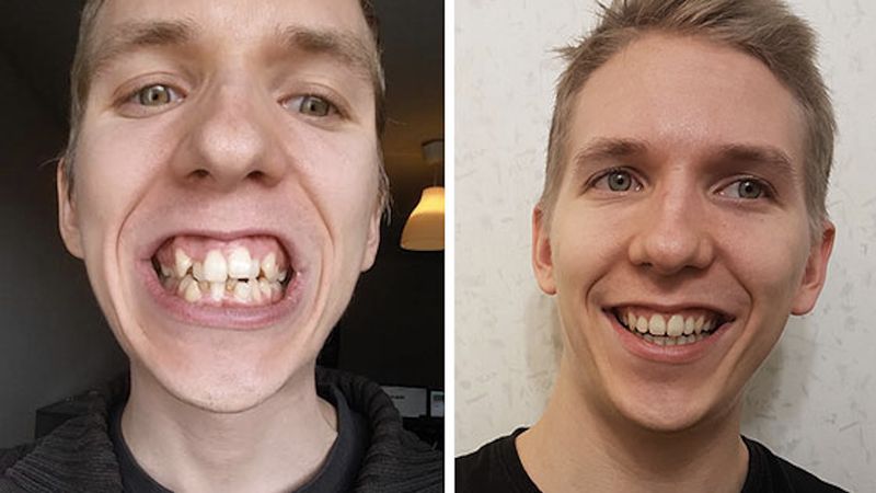 15 osób, które przekonają Cię, że aparat ortodontyczny potrafi zdziałać prawdziwe cuda!