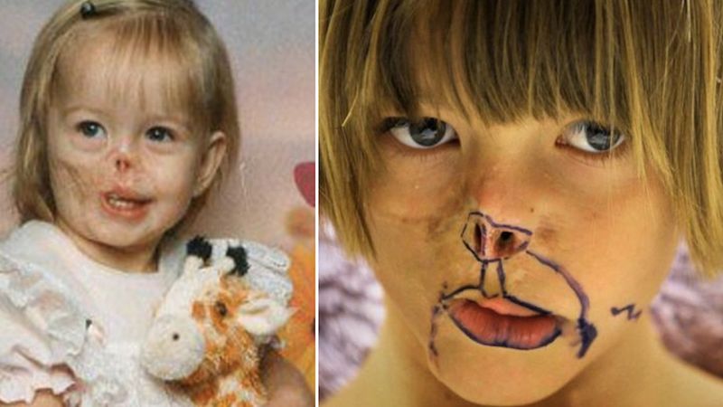 Kiedy miała 3 miesiące została zaatakowana przez szopa. W rezultacie straciła pół twarzy