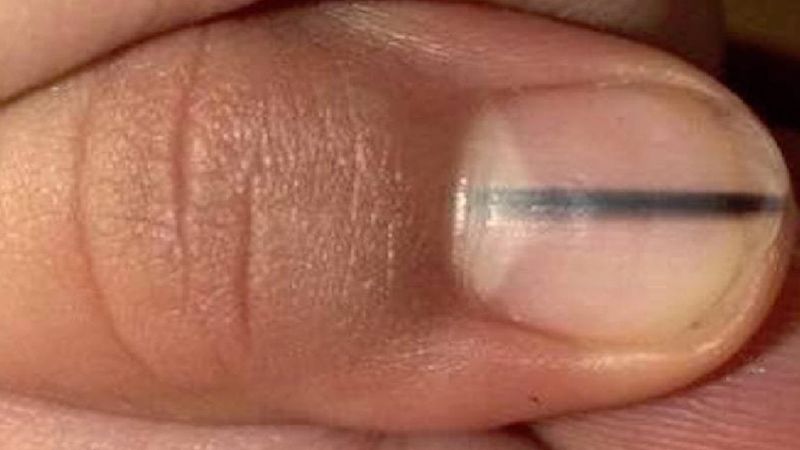 Kosmetyczka w trakcie malowania paznokci zauważyła ciemny pasek na paznokciu klientki