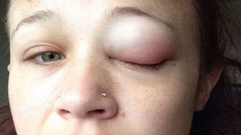 24-latka zdecydowała się na tatuaż oka. Jednak nie wszystko poszło zgodnie z planem