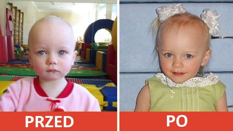 12 zdjęć dzieci przed i po adopcji. Miłość i troska potrafią zmienić naprawdę wiele