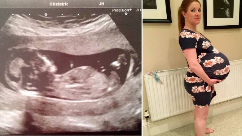 Była w ciąży z bliźniakami. Kiedy przyszły na świat, nie mogła uwierzyć własnym oczom