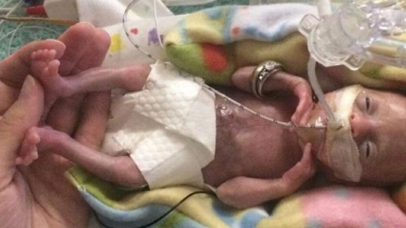 Urodziła się w 21. tygodniu ciąży. Lekarz nie chciał jej reanimować z powodu nierozwiniętych płuc