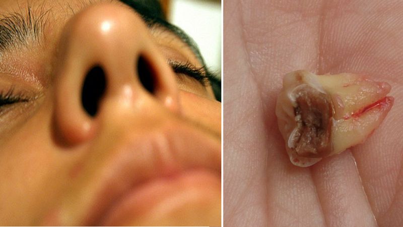 Kobieta od lat skarżyła się na zatkany nos. Okazało się, że w jego wnętrzu wyrósł ząb!