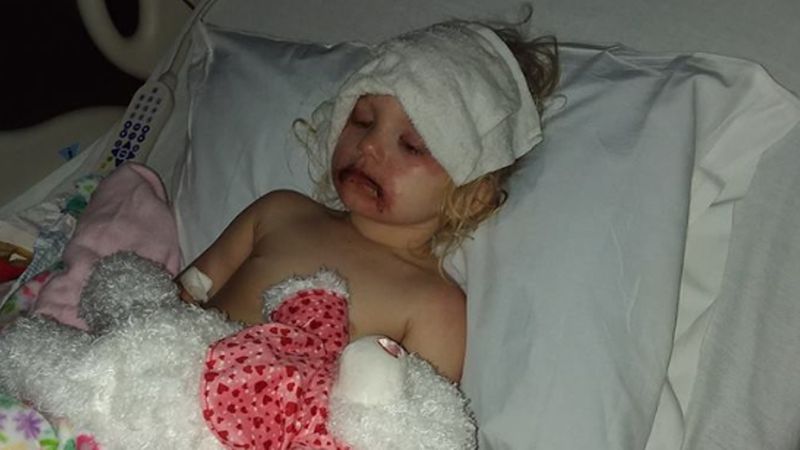 Podzieliła się zdjęciem 3-letniej córki z ranami na buzi. Spowodowała je popularna zabawka
