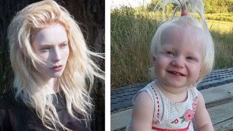 30 osób cierpiących na albinizm. Każda z nich jest na swój sposób wyjątkowa