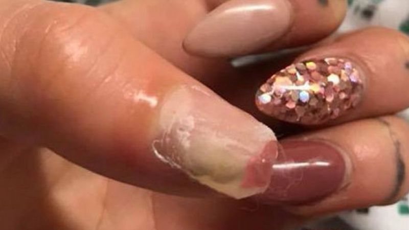 Kosmetyczka zrobiła jej paznokcie. Dwa dni później operacyjnie usunięto jej jednego z kciuka