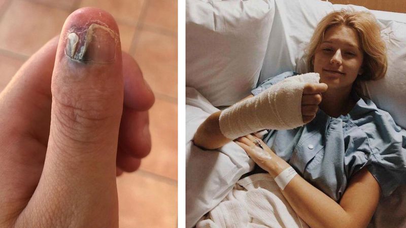 20-latka obgryzła całego paznokcia. Diagnoza dermatologa była bolesna, rak