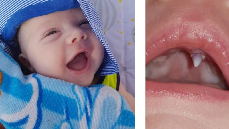 Rano odkryła w buzi 11-tygodniowego synka ząb. Urósł mu przez jedną noc