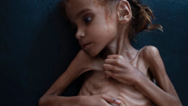 7-letnia dziewczynka zmarła z głodu i wycieńczenia. Jej zdjęcie obiegło cały świat