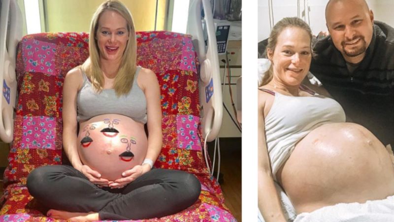 Była w ciąży z trojaczkami. 9 miesięcy później, patrząc na jej ciało, nikt w to nie wierzy