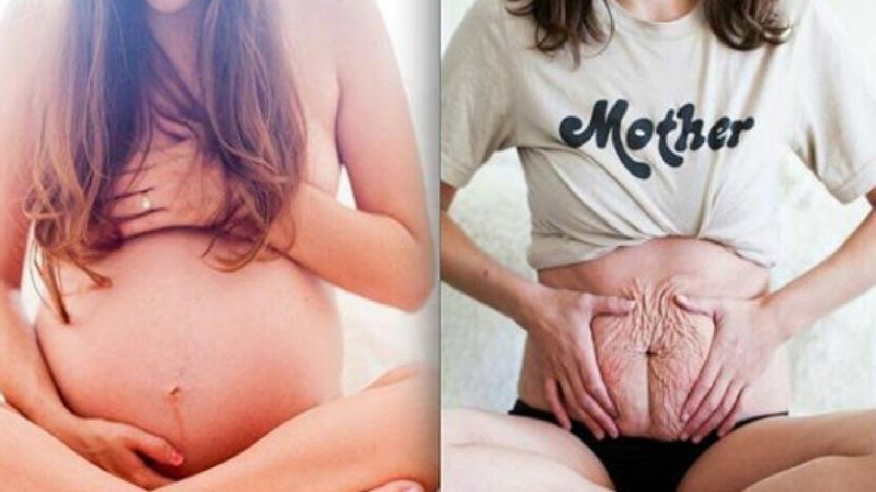 Mamy pokazały, jak w rzeczywistości wygląda brzuch przeciętnej kobiety po porodzie