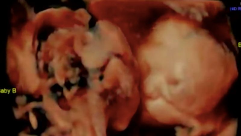 Pacjentka w ciąży bliźniaczej przyszła na USG. Sam lekarz był zdumiony obrazem na monitorze