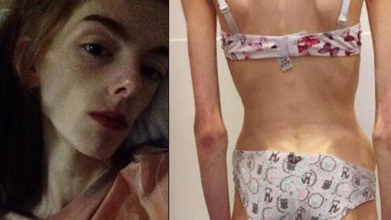 Anoreksja zniszczyła jej życie. Gdy groziła jej śmierć i ważyła 29 kg, zaczęła walkę