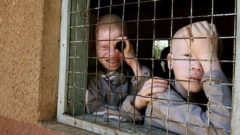 Ludzie chorzy na albinizm nie mogą czuć się bezpieczni. „Polują na nas, jak na łowną zwierzynę”
