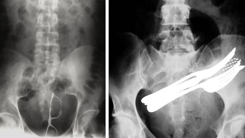 14 zdjęć rentgenowskich, które zdziwiły nawet lekarzy. „Aż mnie boli jak na nie patrzę”