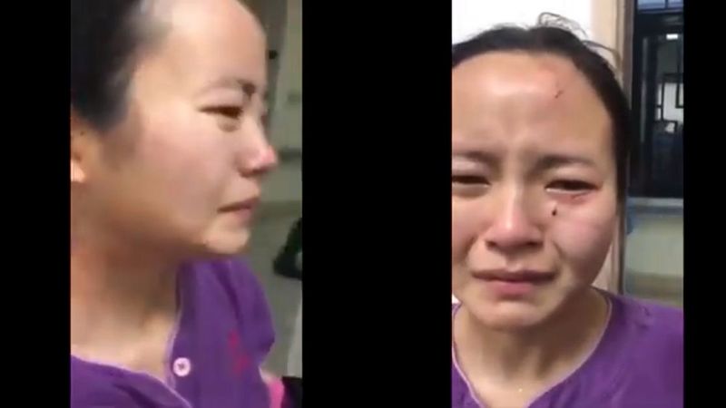 Pielęgniarka pogryziona po twarzy przez pacjentkę