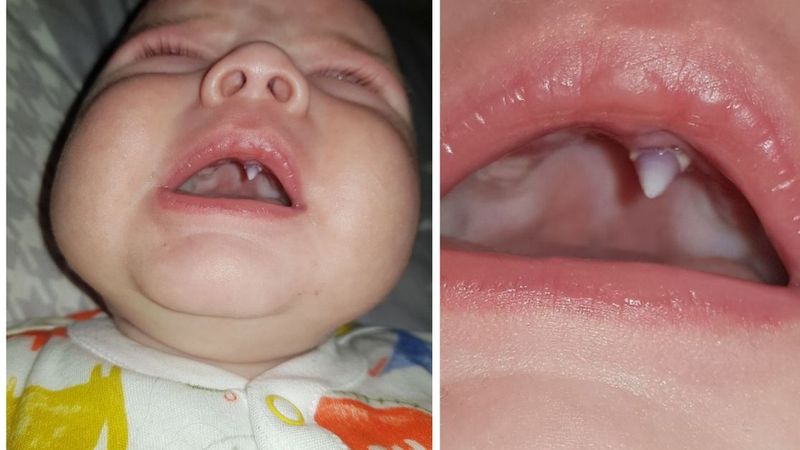 Dziwny ząb wyrósł w ustach maluszka. Lekarze byli zdumieni, gdy go zobaczyli