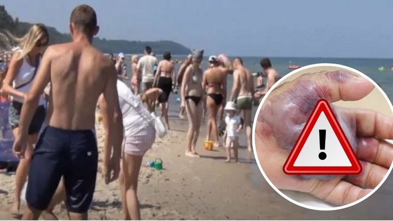 Mięsożerna bakteria w Bałtyku „pożarła” nogę mężczyzny