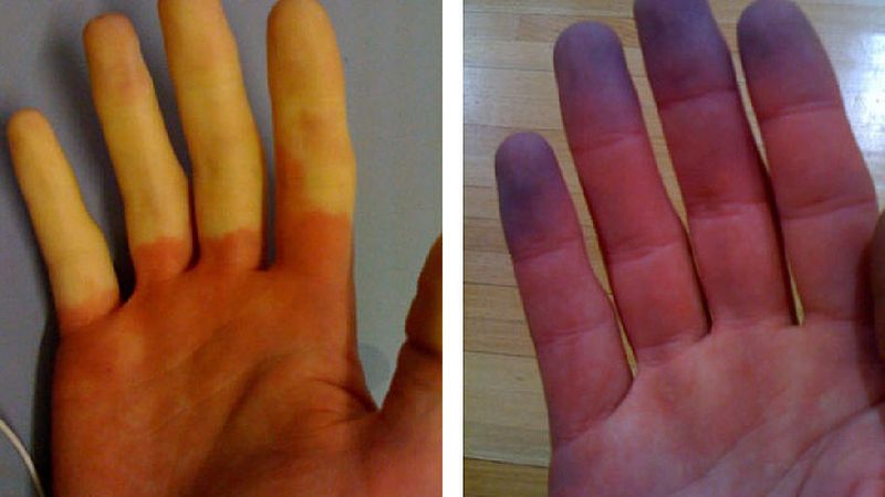 Twoje palce robią się białe lub sine podczas mrozu? To może być objaw choroby