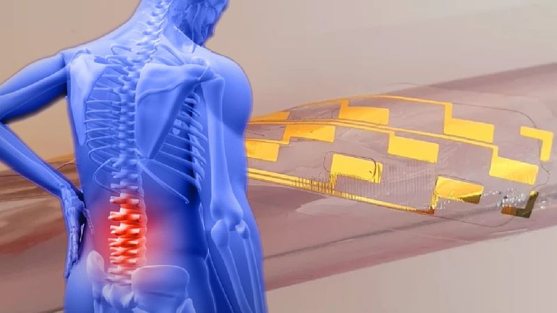 Naukowcy zrobili milowy krok w kierunku zwalczania bólu pleców. Chodzi o innowacyjny implant
