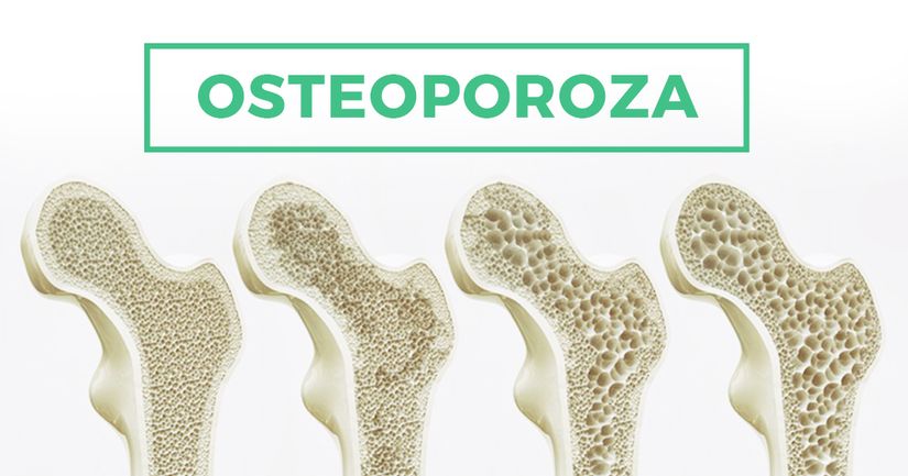 Osteoporoza Przyczyny Objawy I Leczenie Zdrowe Plecy 3705