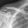FlexBone – materiał do łatania dziur w kościach