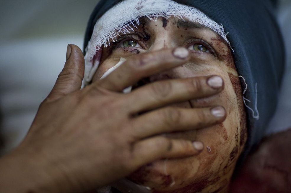 General News Single - 1 miejsce Dramat cywilów podczas wojny w Syrii. Aida straciła rodzinę, a sama została ciężko ranna podczas bombardowania dokonanego przez wojsko syryjskie. Fot. Rodrigo Abd.