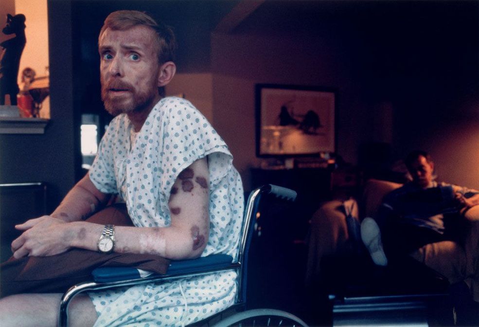 1986 r. San Francisco, USA. Na skórze Kena Meeksa widoczne są uszkodzenia spowodowane przez mięsaka Kaposiego.
Fot. Alon Reininger, World Press Photo of the Year
