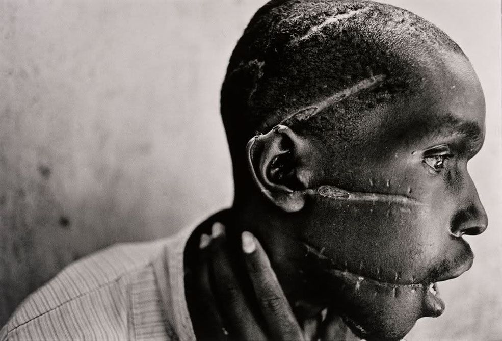 1994 r. Rwanda. Człowiek Hutu w szpitalu Czerwonego Krzyża. Jego twarz została okaleczona przez bojówkę Hutu "Interahamwe", która podejrzewała go o sympatyzowanie z rebeliantami Tutsi. Wrogość między grupami ludności Hutu i Tutsi w Rwandzie była rozniecana przez dziesięciolecia. Śmierć prezydenta Habyarimany w katastrofie lotniczej w pobliżu stolicy Kigali wywołała zbrodnicze ataki.
Fot. James Nachtwey, World Press Photo of the Year