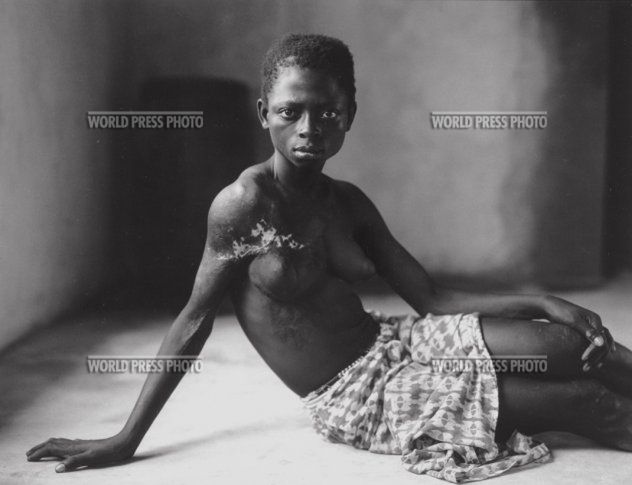 15 12-letnia mieszkanka Sierra Leone, uprowadzona przez rebeliantów z RUF i okaleczona podczas próby ucieczki. Podczas trwającej 11 lat wojny dzieci ucierpiały szczególnie okrutnie. Fot. Brent Stirton, 2002.
