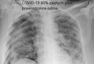 Co się dzieje w płucach w czasie COVID-19? Lekarz tłumaczy