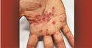 Nietypowe plamy na dłoniach mogą świadczyć o zakażeniu wirusem opryszczki 