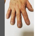 Palce pałeczkowate to jeden z objawów chorobowych. O jakich schorzeniach świadczą?