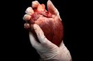 Przeszczep serca - co to jest, wskazania, przeciwwskazania, powikłania