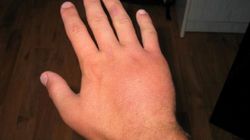 Spuchnięte dłonie - objawy, przyczyny i leczenie