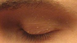 Małe grudki na twarzy. Wyjaśniamy, czym są prosaki i jak się ich pozbyć