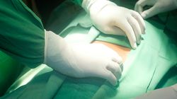 Możliwość powikłań po wycięciu wyrostka robaczkowego