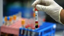 Gamma-globuliny- czym są, normy, wskazania do badania