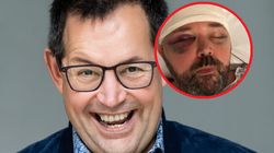 Guzy w jego mózgu rosły przez pięć lat. Jedynym objawem był ból głowy