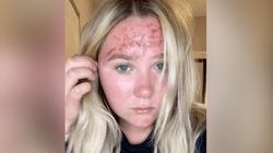 Nałożyła przeterminowany krem z filtrem. "Nigdy nie zapomnę wyrazu twarzy lekarza"