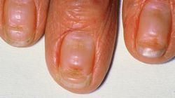 Znak, że cukrzyca już zaatakowała. Charakterystyczny szczegół widać na paznokciach