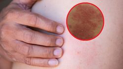 Tak dużo zachorowań nie było od 9 lat. Błyskawicznie dochodzi do sepsy