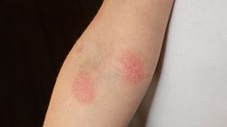 Poznaj powszechne problemy skórne dzieci