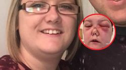 Cierpi na rzadką chorobę. Jej nos dosłownie się zapadł