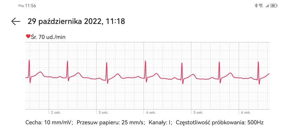 Wykres EKG