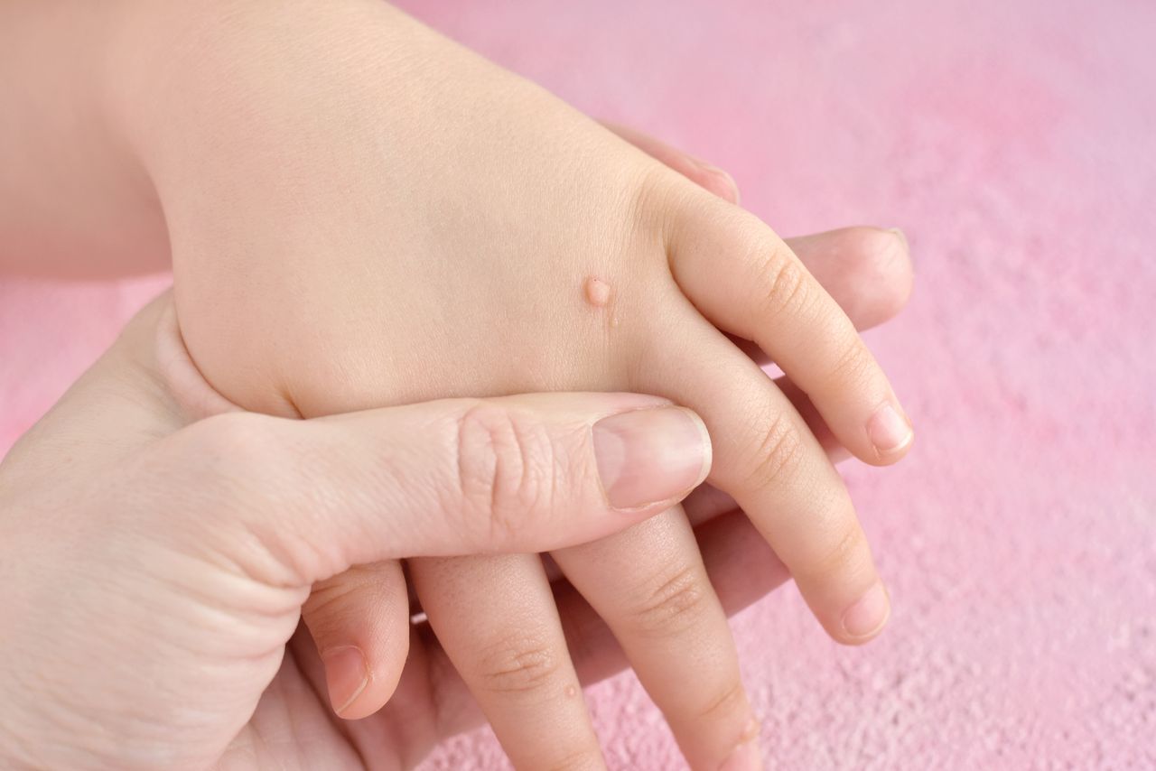 Szacuje się, że ok. 75% populacji przynajmniej raz w życiu miało brodawki [2]. To powszechny problem medyczny i jedna z częstszych przyczyn wizyt u dermatologa.