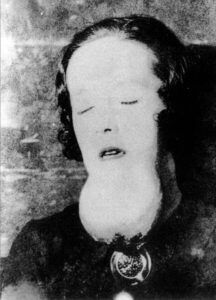 Szczęka u radowej dziewczyny. Fot. domena publiczna